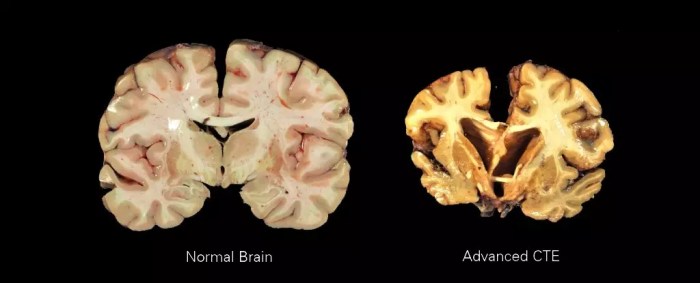 Do rugby players get cte