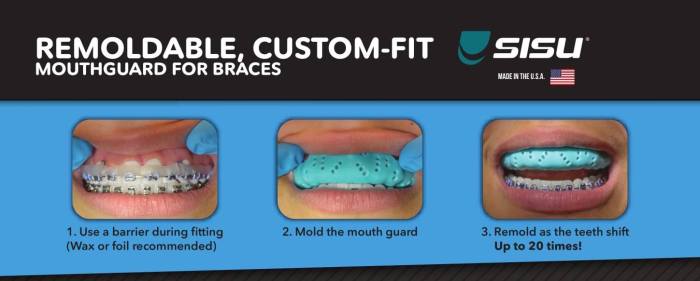 Can you play rugby with braces