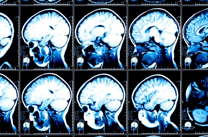 Concussion concussions symptoms lasting loss problems consciousness Concussion concussions symptoms lasting loss problems consciousness