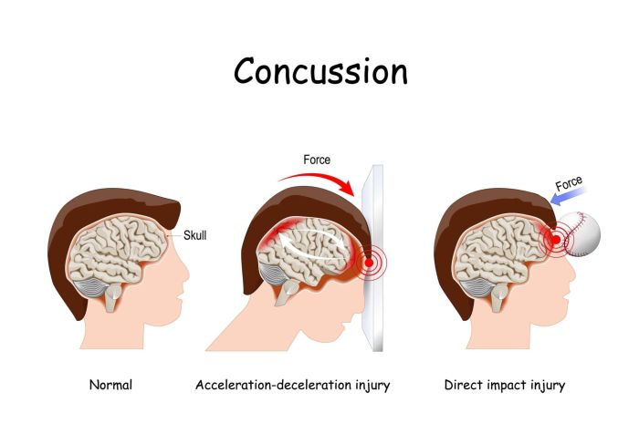 Does rugby cause brain damage