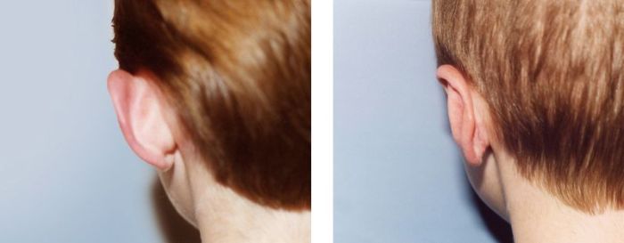 How to remove cauliflower ears?