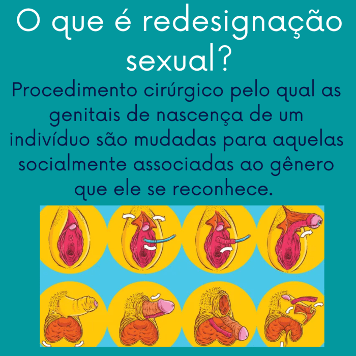 CIRURGIA DE REDESIGNAÇÃO SEXUAL - Fisioterapia CIRURGIA DE REDESIGNAÇÃO SEXUAL - Fisioterapia