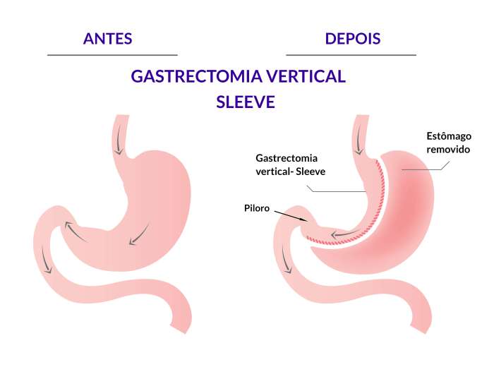 SLEEVE - Gastrectomia vertical Metodo Sleeve Cirurgia Bariatrica