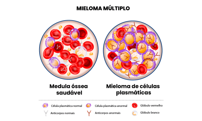 Dia Mundial do Mieloma Múltiplo – Juliana Salvador | Médica ... Mieloma Múltiplo Tem Cura