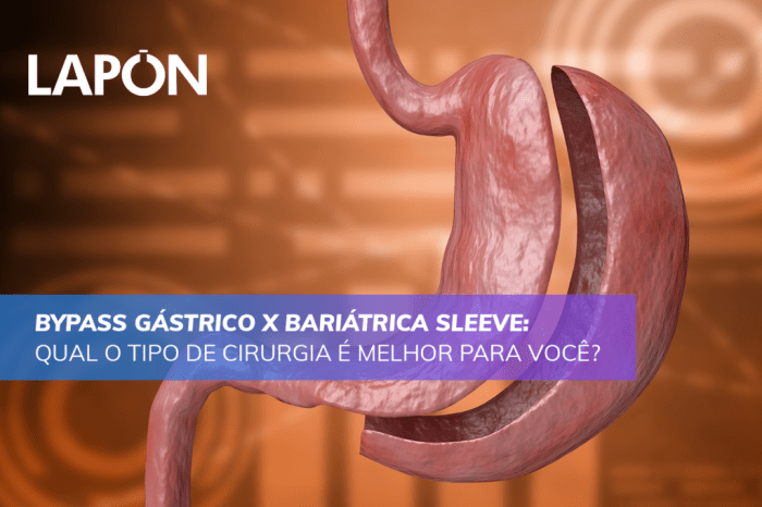 Bypass Gástrico X Bariátrica Sleeve: Qual é o melhor tipo? Bypass Gástrico X Bariátrica Sleeve: Qual é o melhor tipo?