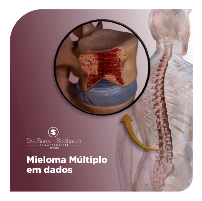 O que é Mieloma Múltiplo? Conheça o Câncer das Células Plasmáticas O que é Mieloma Múltiplo? Conheça o Câncer das Células Plasmáticas