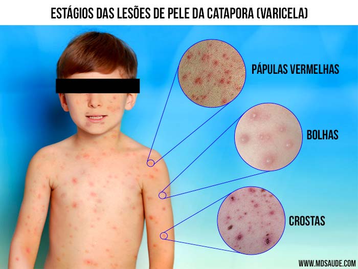 CATAPORA (varicela) | Transmissão, sintomas e tratamento CATAPORA (varicela) | Transmissão, sintomas e tratamento
