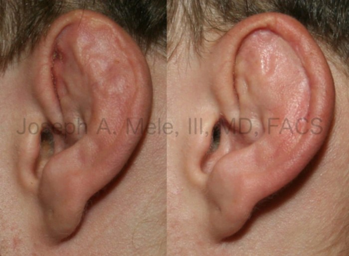 How to remove cauliflower ears?