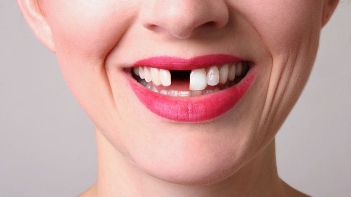 Foto de Um Dente De Plástico Falso Odontologia Dentes Protéticos Placas ...