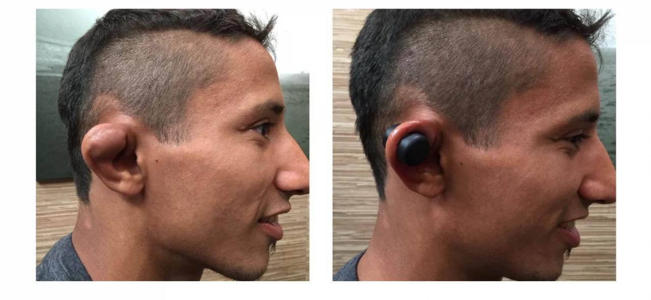 Why can't cauliflower ear be fixed?