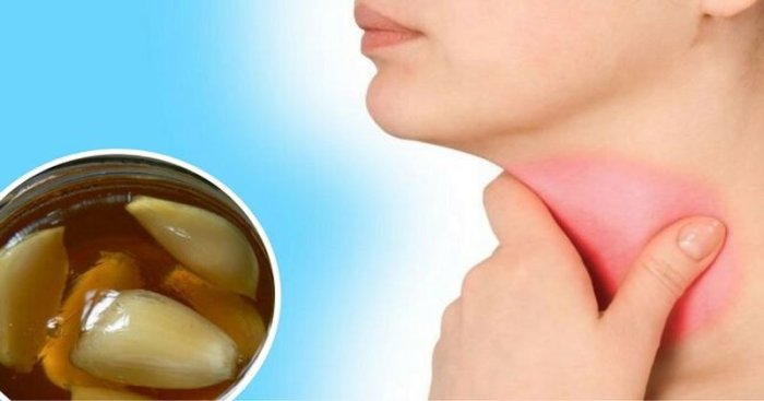 8 Excelentes Remédios Caseiros Para Dor de Garganta - Vital Ervas ... Remedios Pra Dor De Garganta