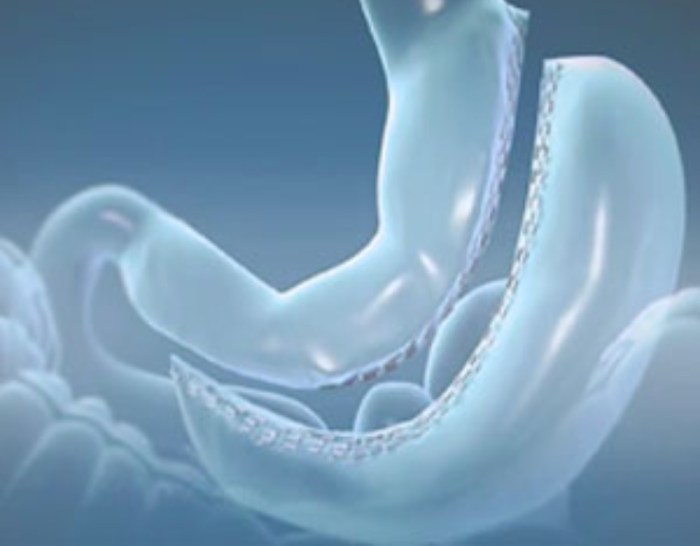 CIRURGIA DA BARIÁTRICA: BYPASS OU SLEEVE ? DIFERENÇAS ? QUAL A MELHOR ... Metodo Sleeve Cirurgia Bariatrica