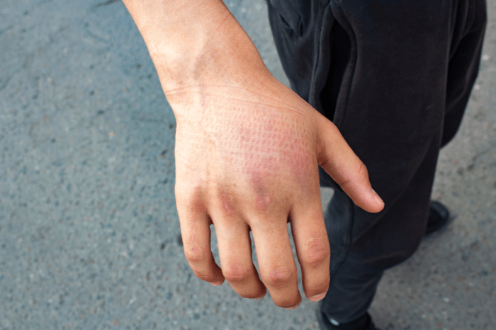 Can you play rugby with broken fingers?