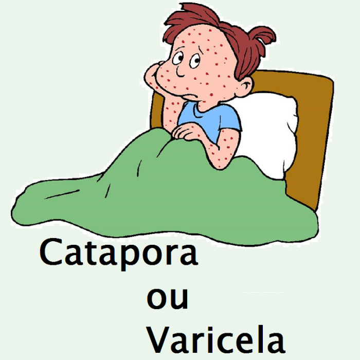 Catapora ou Varicela – PediatriaVirtual.com Varicela E Catapora É A Mesma Coisa