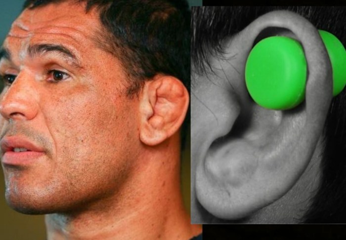 How to remove cauliflower ears?
