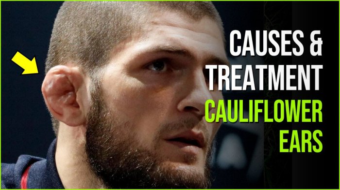 What happens if you ignore cauliflower ear?