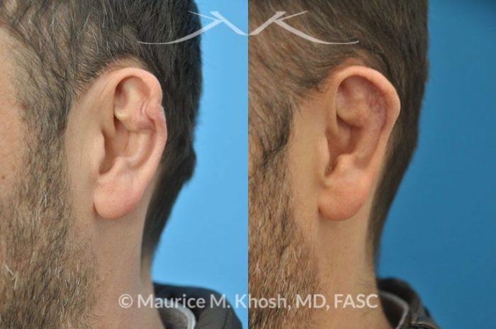 How to remove cauliflower ears?