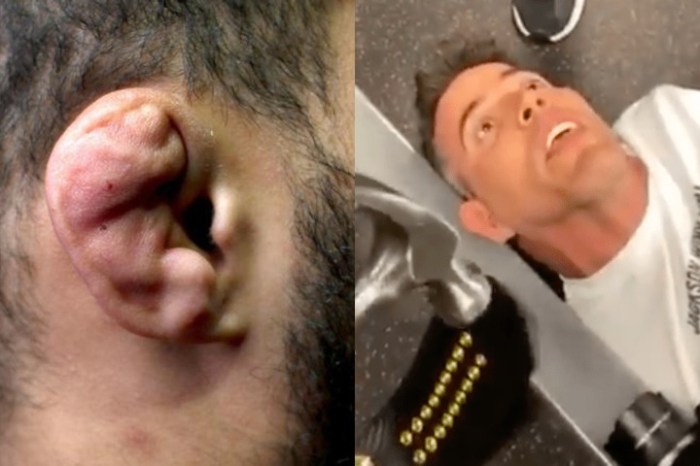 What happens if you ignore cauliflower ear?