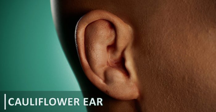 Ear cauliflower ears fighters ufc weird thesun treatment bjj happen prevent fighter