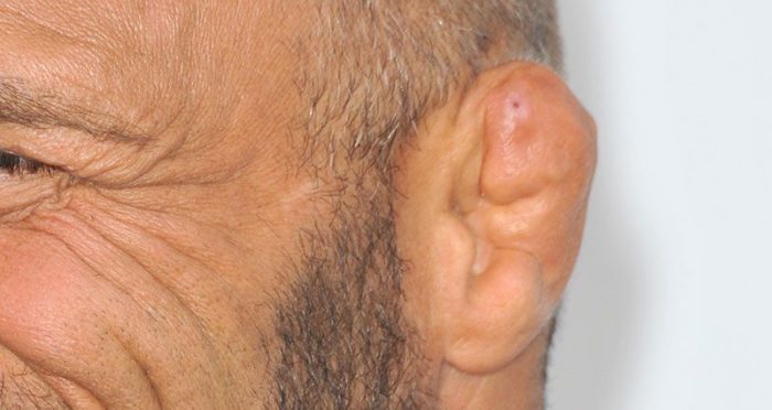 What happens if you ignore cauliflower ear?
