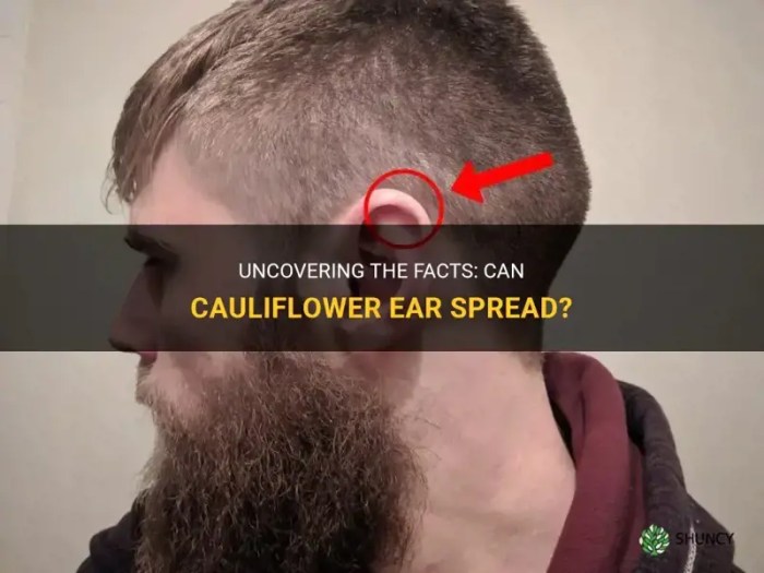 How do humans get cauliflower ear?