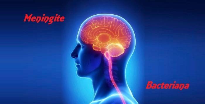 Meningite bacteriana, fique atento aos sintomas. Meningite Bacteriana