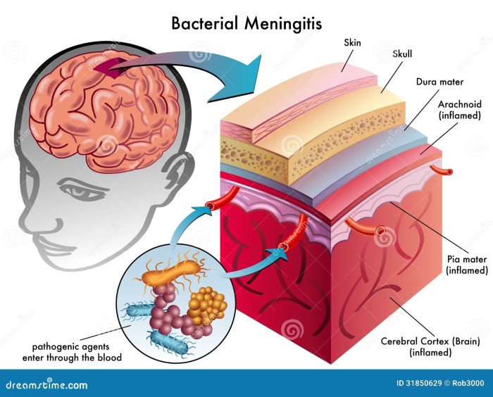 Med é pop: MENINGITE BACTERIANA : imagens elucidativas Meningite Bacteriana