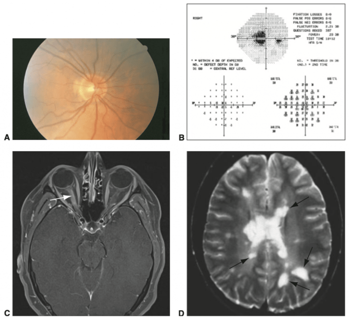 Neurite vestibular: remédios naturais para combatê-la - Melhor com Saúde Neurite Tem Cura