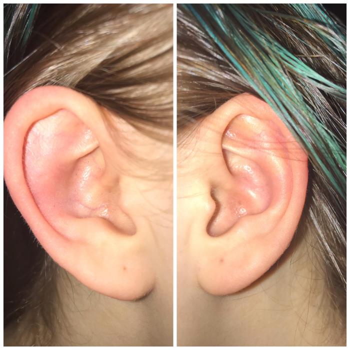 Does cauliflower ear affect hearing?
