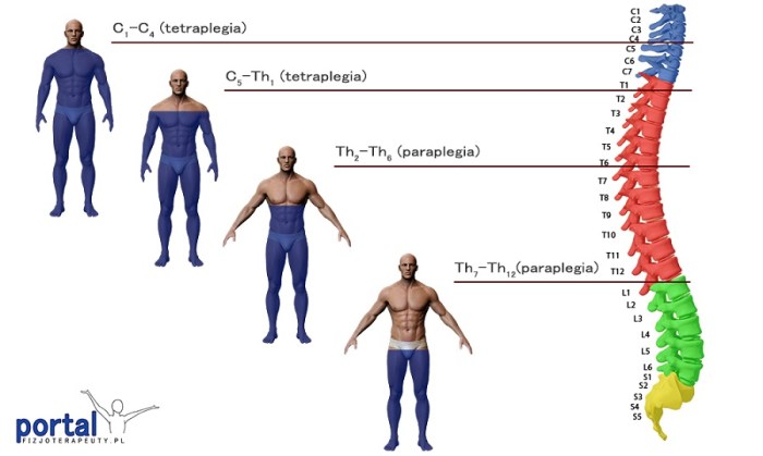 Veja e Reveja!: PARAPLEGIA E TETRAPLEGIA Veja e Reveja!: PARAPLEGIA E TETRAPLEGIA