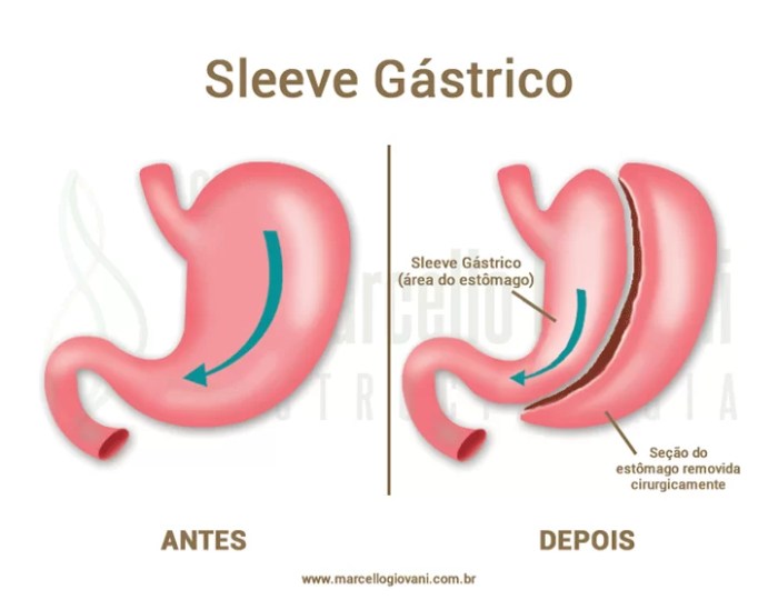 Cirurgia Bariátrica Sleeve - Dr Marcello Giovani - Gastrocirurgia Cirurgia Bariátrica Sleeve - Dr Marcello Giovani - Gastrocirurgia