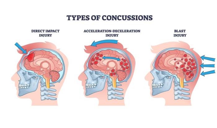 Which sport has the least concussions?