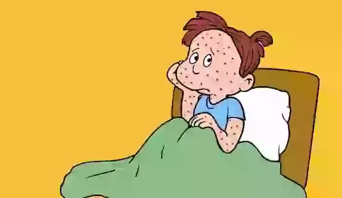 CATAPORA (VARICELA): SINTOMAS E TRATAMENTO | Pediatria Sem Segredo CATAPORA (VARICELA): SINTOMAS E TRATAMENTO | Pediatria Sem Segredo