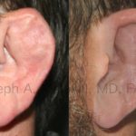 Why can't cauliflower ear be fixed?