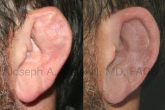 Why can't cauliflower ear be fixed?
