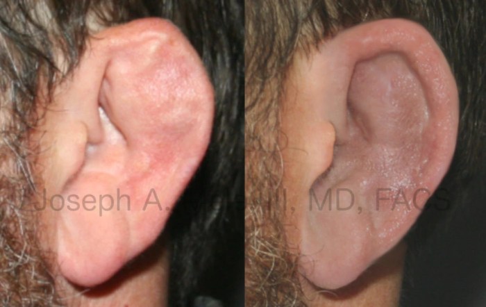 Why can't cauliflower ear be fixed?