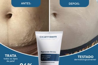 Creme para Estrias Cicatribem 150g - Trata Todos os Tipos de Estrias ...