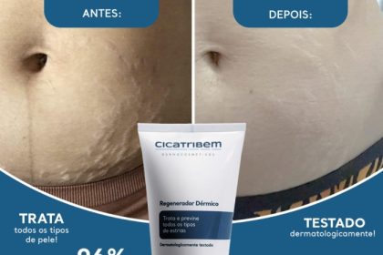 Creme para Estrias Cicatribem 150g - Trata Todos os Tipos de Estrias ...