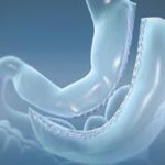 Metodo Sleeve Cirurgia Bariatrica