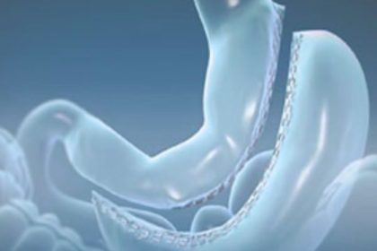 Metodo Sleeve Cirurgia Bariatrica