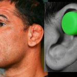 How to remove cauliflower ears?