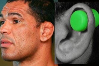 How to remove cauliflower ears?