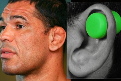 How to remove cauliflower ears?