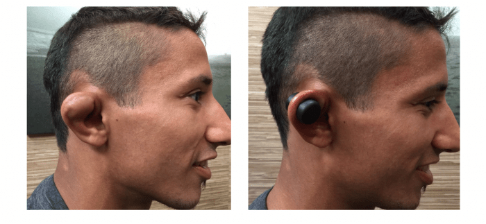 How do humans get cauliflower ear?