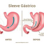 Cirurgia Bariátrica Sleeve - Dr Marcello Giovani - Gastrocirurgia