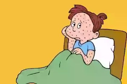 CATAPORA (VARICELA): SINTOMAS E TRATAMENTO | Pediatria Sem Segredo